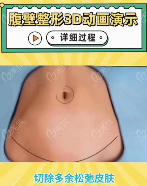 236z.com腹壁成形手术