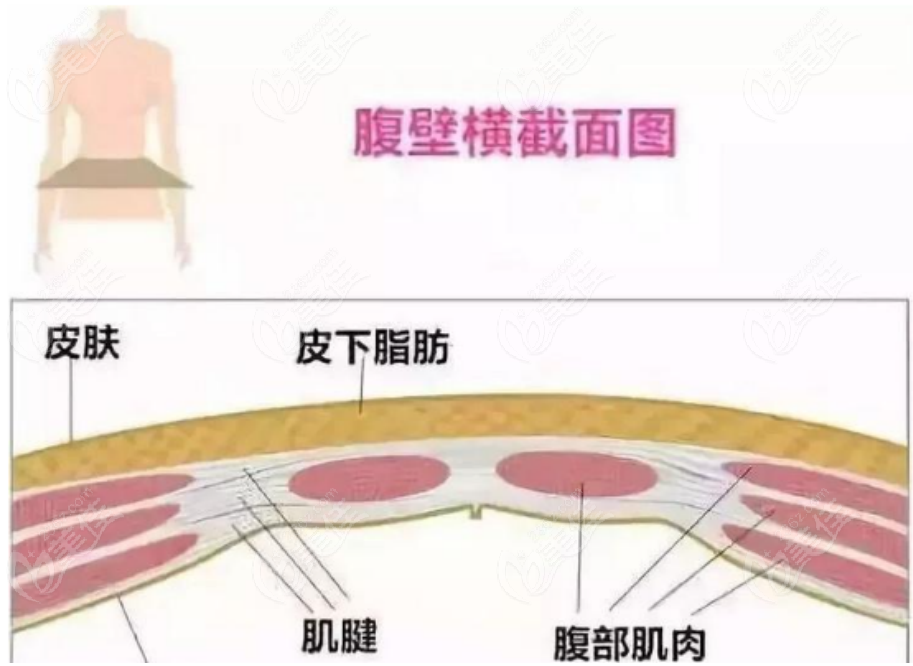 236z.com崔东医生做腹壁成形手术