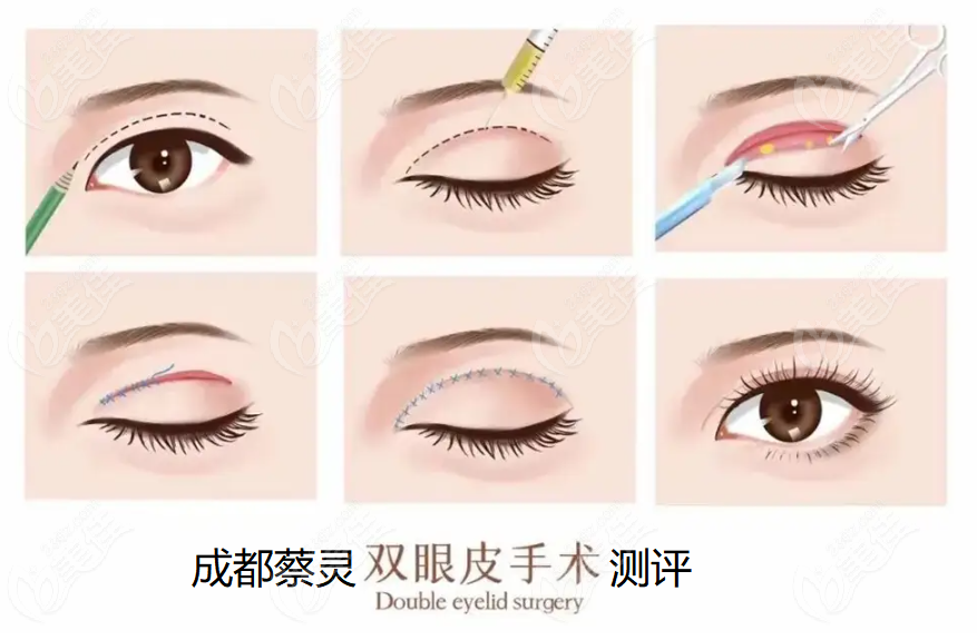 成都蔡灵做眼睛测评