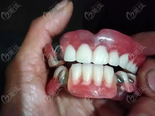玉溪装活动假牙价格表