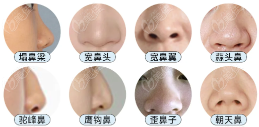 成都新華醫(yī)院陶俊醫(yī)生整鼻子怎么樣