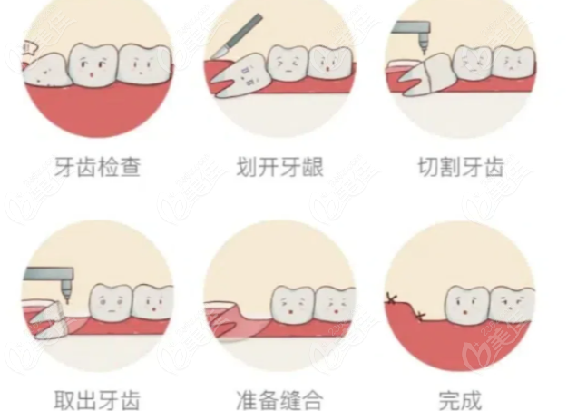 拔牙流程