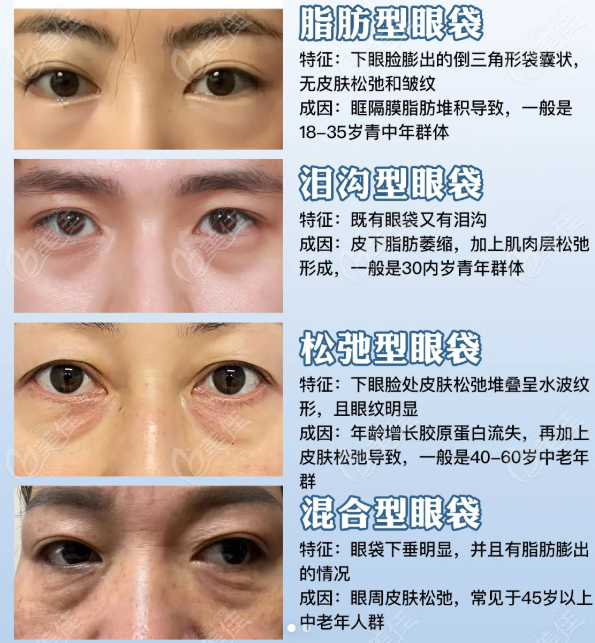 张志兵去眼袋有后遗症吗