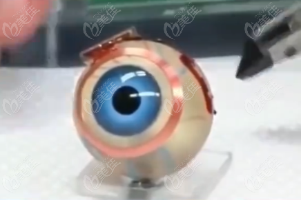 3D仿生眼球2025年能上市吗