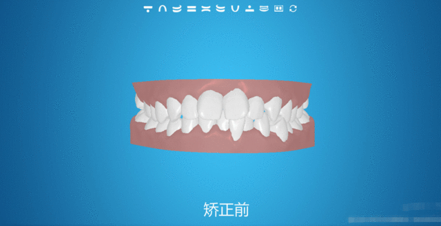 牙齿矫正