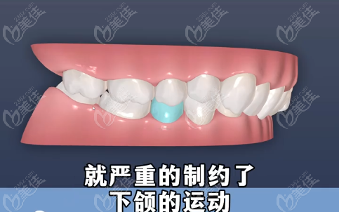 内倾深覆合