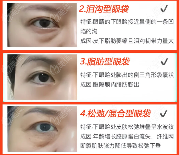北京白明做眼袋好