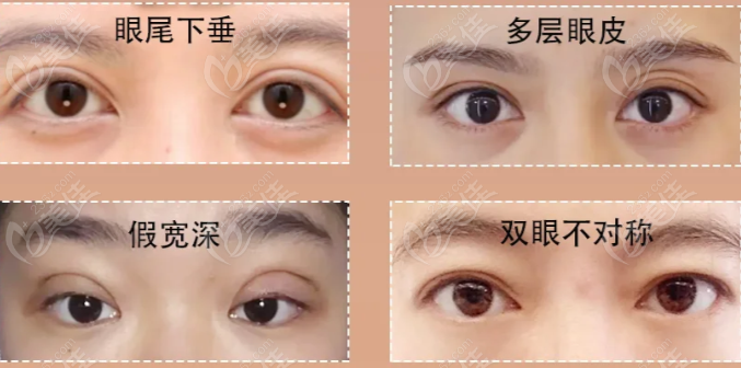 雙眼皮失敗修復(fù)類型 雙眼皮失敗修復(fù)類型
