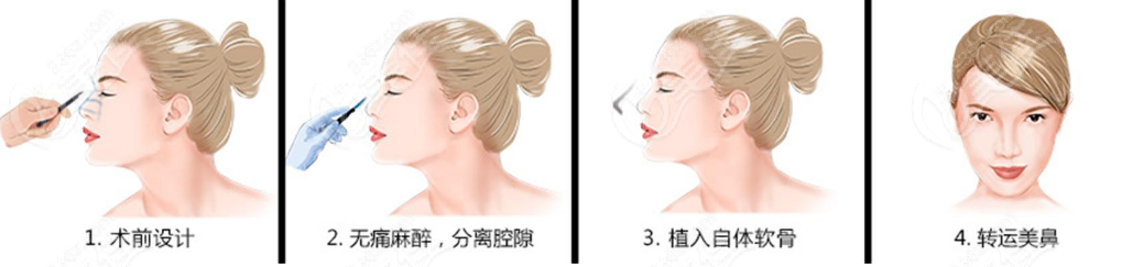 潘衛(wèi)峰醫(yī)生隆鼻失敗修復(fù)技術(shù)優(yōu)勢(shì)