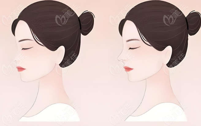 李健肋骨鼻修復(fù)成效前后對(duì)比