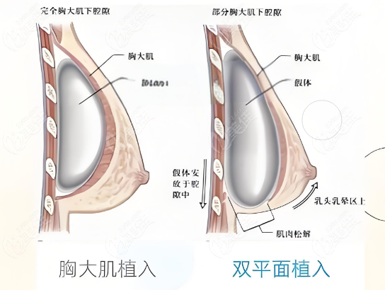 肖征刚做胸部整形技术优势