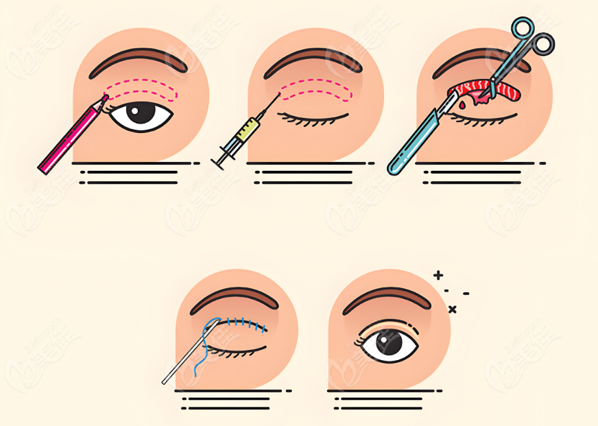 双眼皮修复过程图