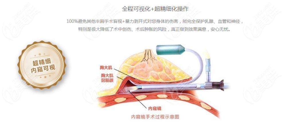 王谊医生隆胸技术好