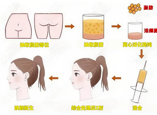 朱慧东脂肪填充技术优势