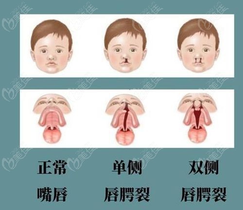 唇腭裂二次修复手术哪里现在免费