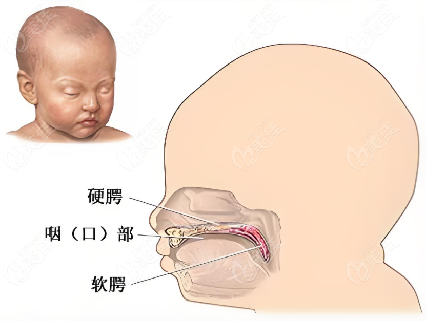 唇腭裂手术www.236z.com