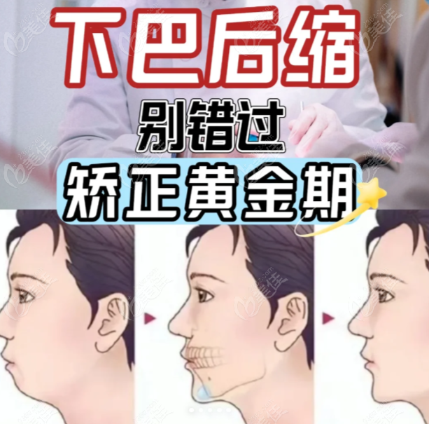 下巴后缩矫正