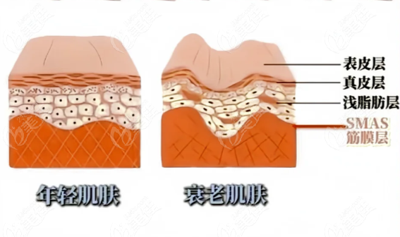 筋膜提升