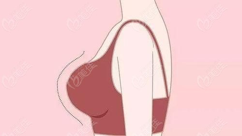 南京裴旭芳自体脂肪隆胸怎么样