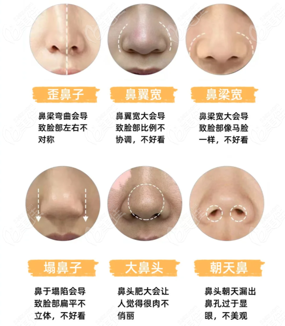 成都西區(qū)整形醫(yī)院做鼻子技術(shù)優(yōu)勢