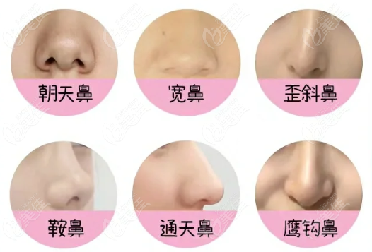 段焘隆鼻实例