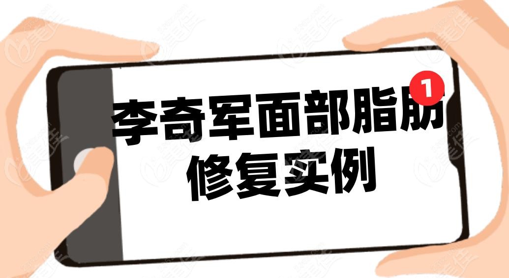 李奇軍面部脂肪修復實例