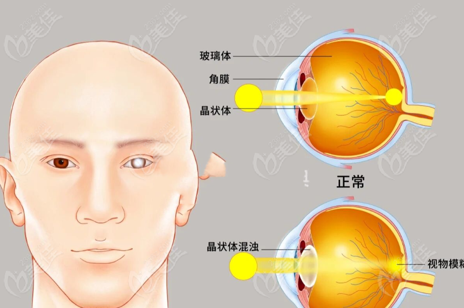 北京白内障免费手术政策