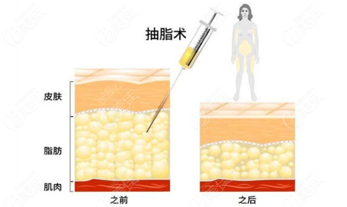 北京趙軍艦醫(yī)生吸脂