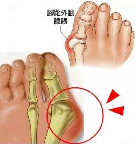 沈阳马文足科正规吗？30年院长亲诊揭秘：拇外翻矫正当天走路技术解析