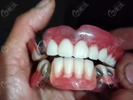 泸州活动假牙价格表