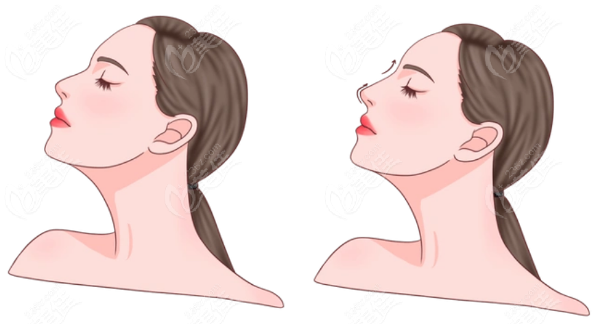 杨千里隆鼻实例