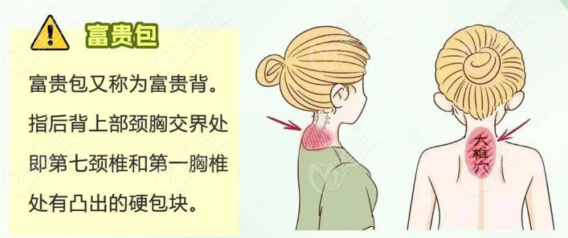 深圳富貴包抽脂費(fèi)用