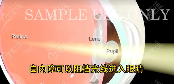 白內(nèi)障去哪里申請免費(fèi)