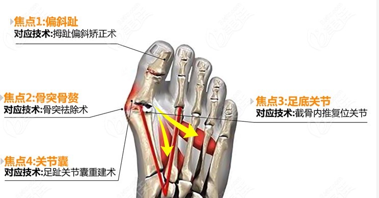 上海虹桥医院看大脚骨可靠