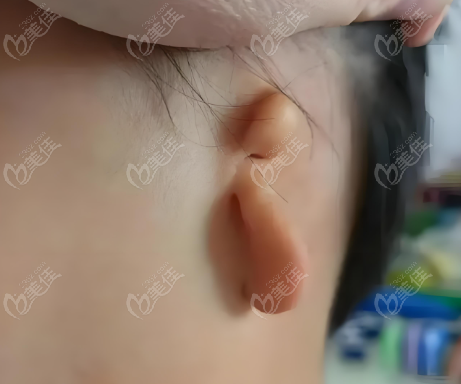 小耳症