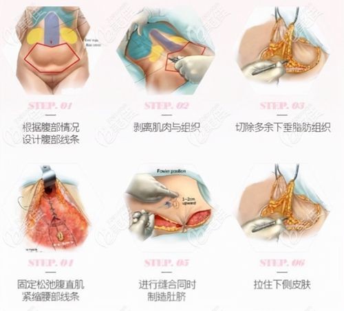 腹壁整形术全过程3D动画解析