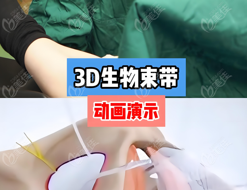 海做3D生物束带哪家医院技术好