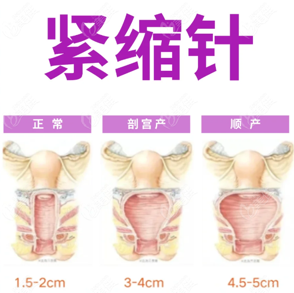 2025年正规医院打紧缩针价格