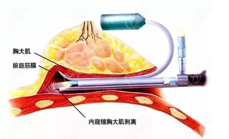 吴振医生假体隆胸技术好价格便宜