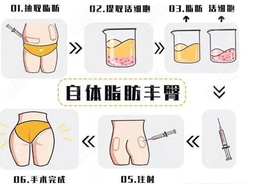国内自体脂肪丰臀好的医生