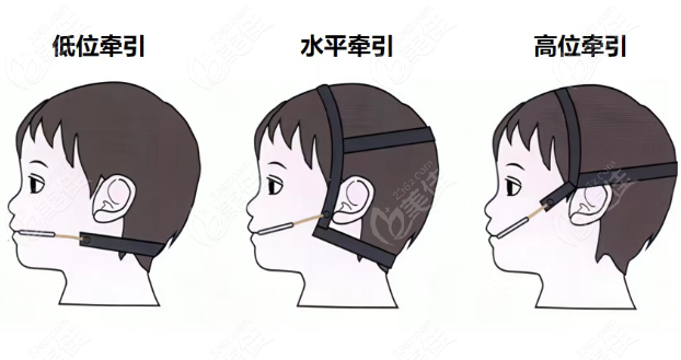 矫正牵引器