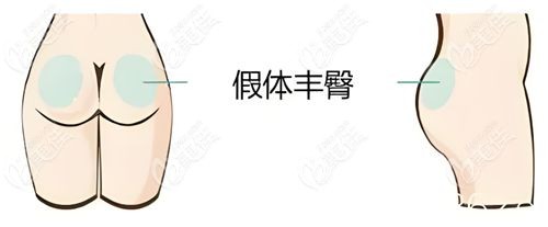 杭州假体丰臀比较好的医生