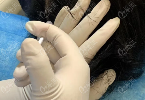 cgf治疗脱发一疗程打几针