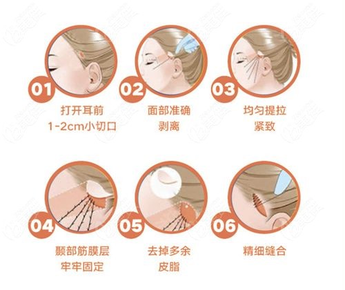 面部提升三件套三类并发症