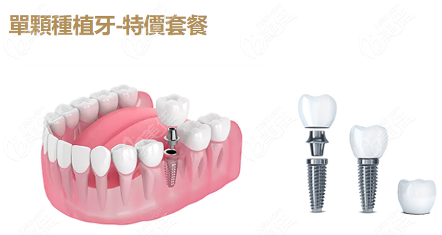 深圳鵬程口腔種牙品牌