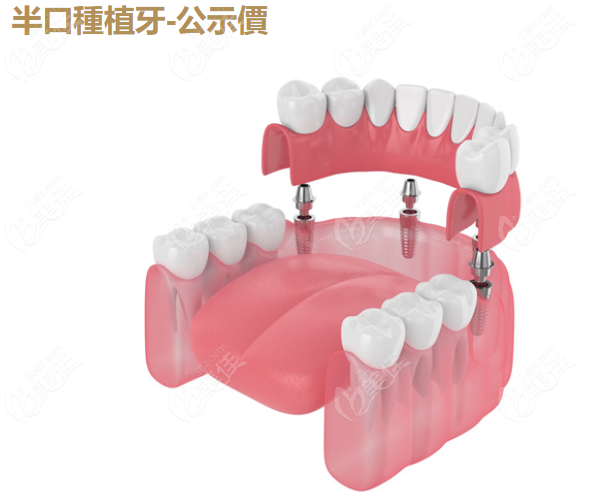腔半口種牙價目表