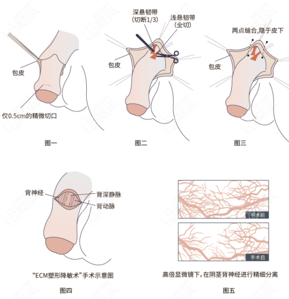 李世荣阴茎延长增粗手术口碑评价