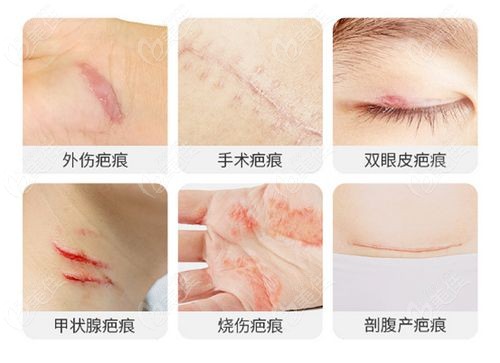 武汉华美疤痕修复中心价格表