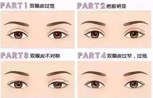 蘇州陳光修復(fù)雙眼皮怎么樣