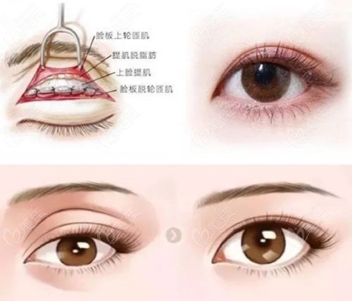 蘇州陳光修復(fù)雙眼皮技術(shù)好
